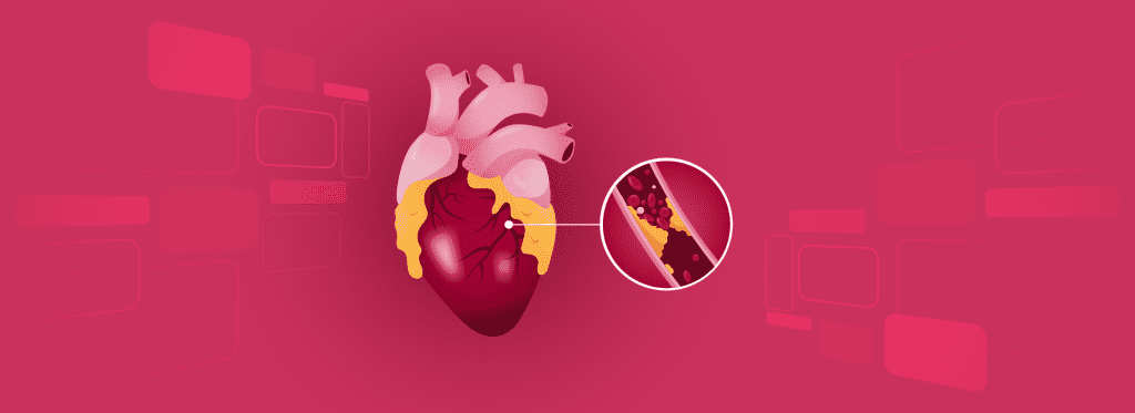 Meta Analysis, Rapid algorithms, high sensitivity troponin, AMI, ED, hs-cTN